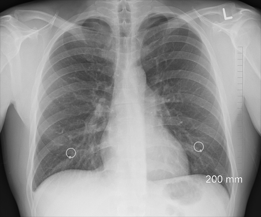 W kilka minut możesz sprawdzić pojemność płuc. W szpitalu w Słupsku i na Polankach skorzystaj z bezpłatnej spirometrii