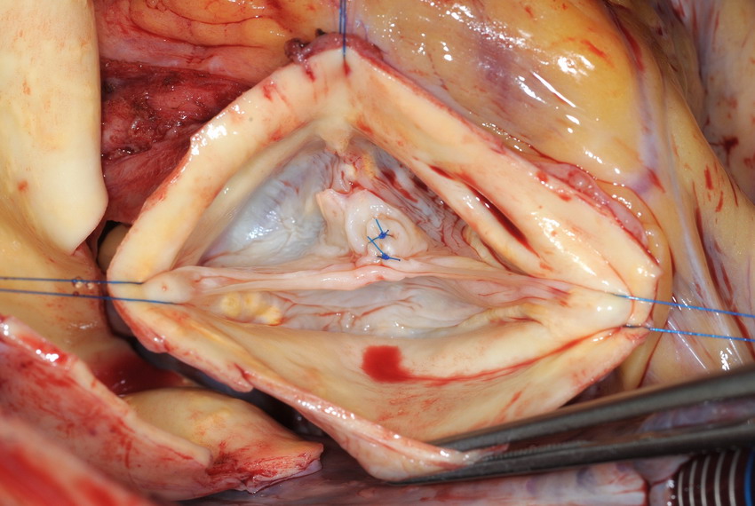Wejherowscy kardiochirurdzy naprawiają zastawki aortalne. Kto może być poddany zabiegowi?
