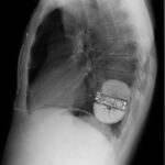 Zdjęcie RTG klatki piersiowej z boku ze wszczepionym kardiowerterem