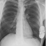 Zdjęcie RTG klatki piersiowej z przodu ze wszczepionym kardiowerterem