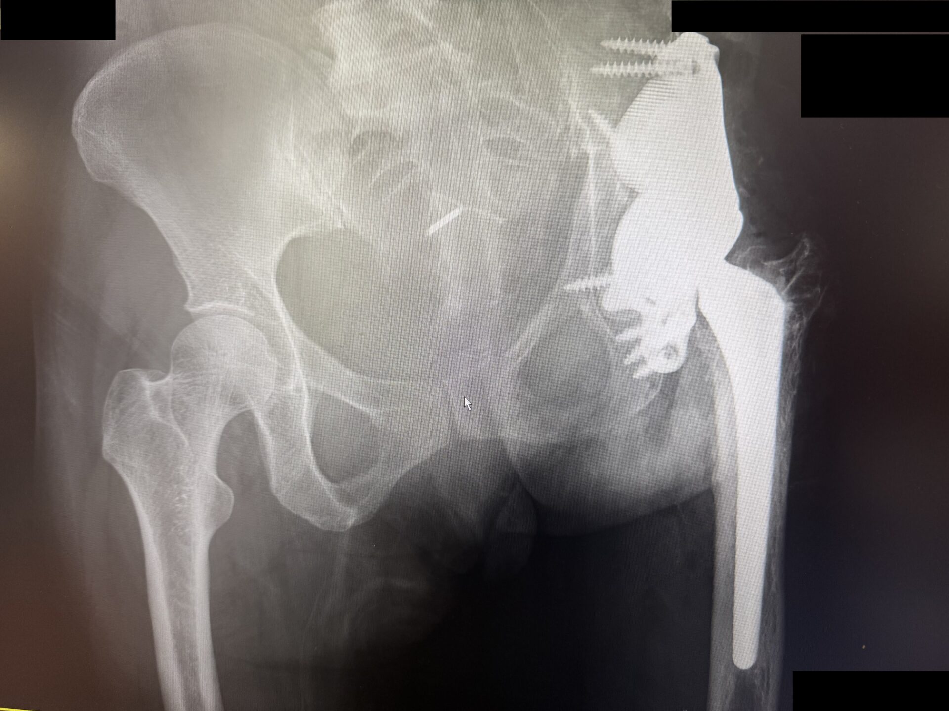 endoporteza stawu biodrowego z drukarki 3 D